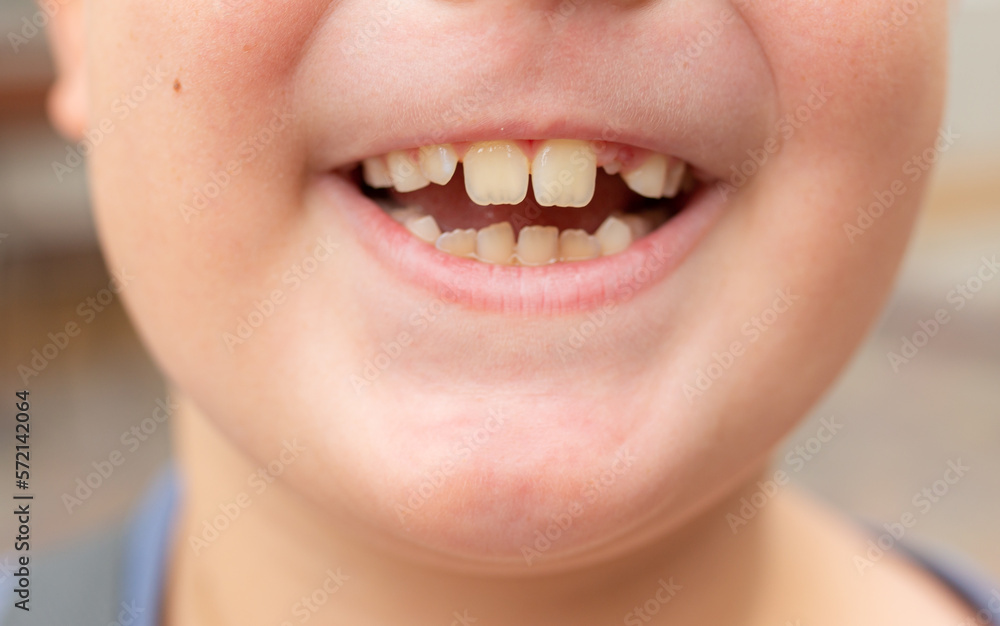 Close-up of a boy showing a fallen tooth. Loss of teeth, concept of dental problems Close-up of a boy showing a fallen tooth. Loss of teeth, concept of dental problems