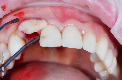 Foto Soft tissue augmentation procedures