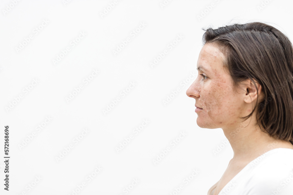 Photo of side view of woman with damaged skin. Photo of side view of woman with damaged skin.
