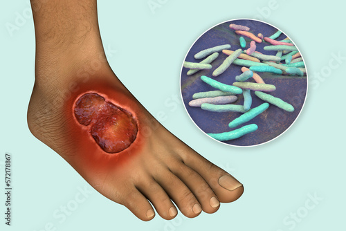 Buruli ulcer on a patient foot, 3D illustration. The disease caused by Mycobacterium ulcerans bacteria photo