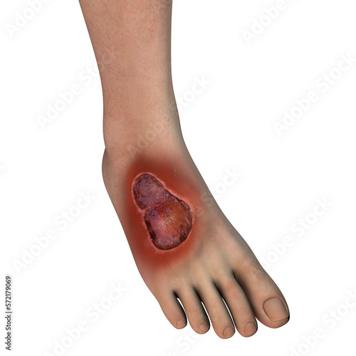 Buruli ulcer on a foot, 3D illustration. The disease caused by Mycobacterium ulcerans bacteria photo