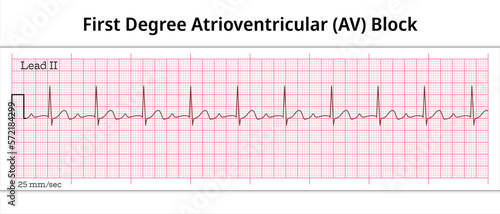 ECG First Degree Atrioventricular Block - 1st degree AV Block - 8 Second ECG Paper - Electrocardiography Vector Medical Illustration
