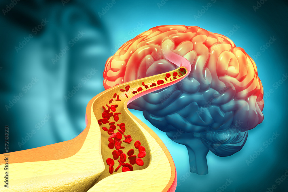 Atherosclerosis Stroke. A blood clot in the vessels of the human brain