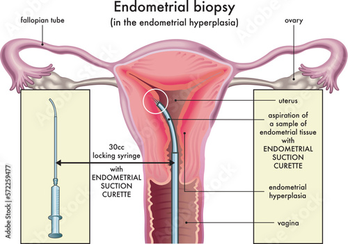 Medical illustration  of the endometrial biopsy procedure in the endometrial hyperplasia with annotations.