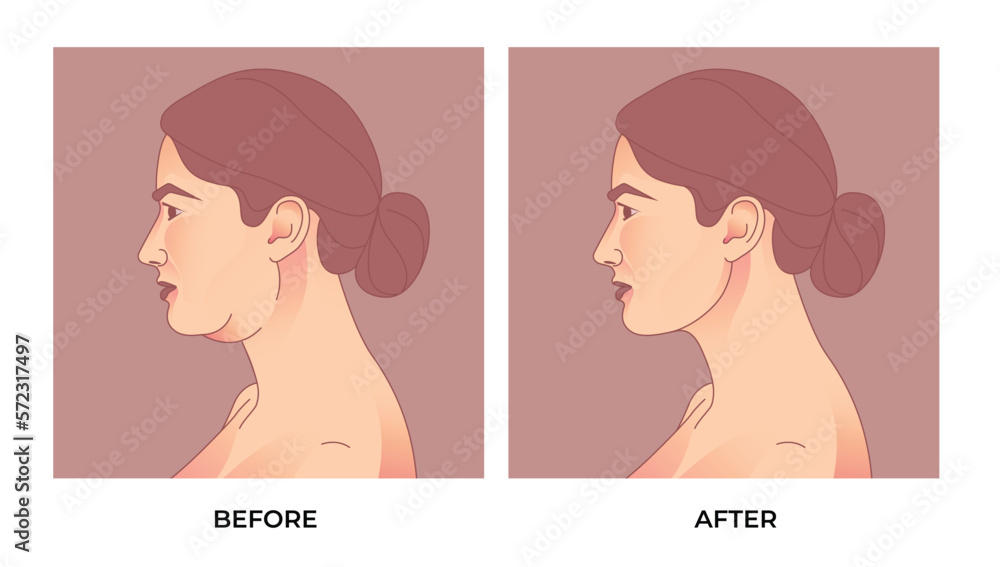 Double Chin Liposuction. before and after Brachioplasty, liposuction or