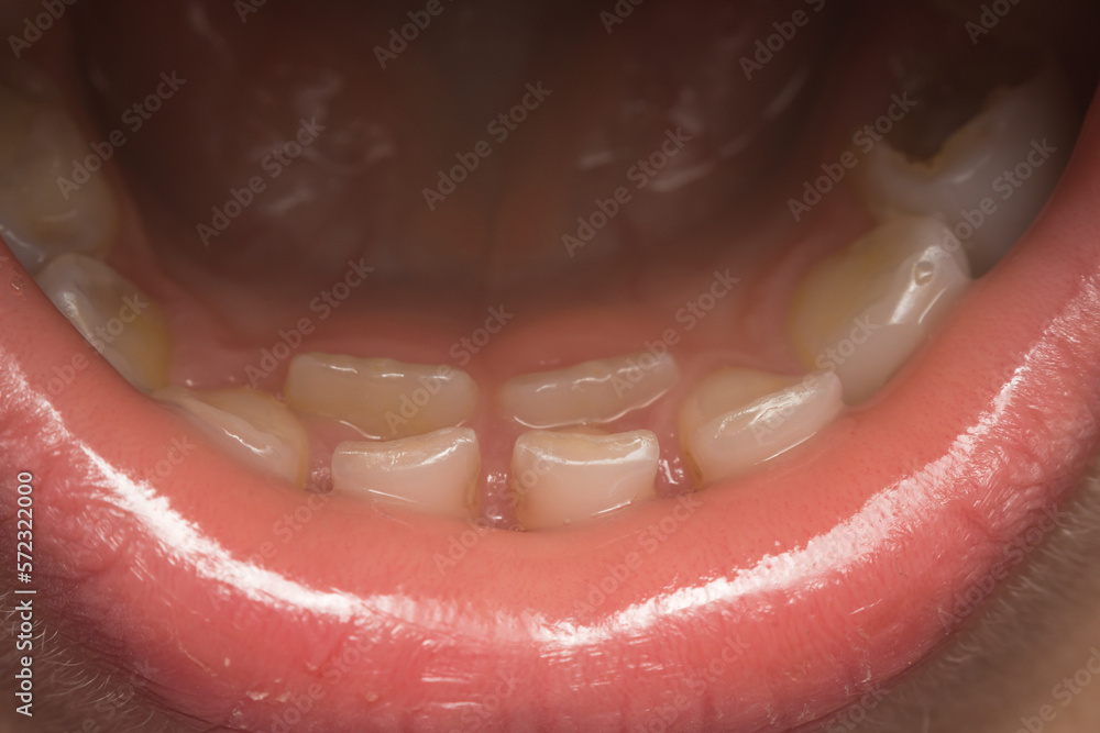 Obraz premium child mouth before deciduous teeth extraction