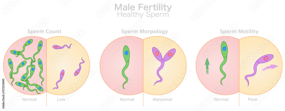 Male fertility, sperm healthy. Count, morphology, motility. Compare, normal, low, abnormal, poor. Collecting semen, movement shape. Microscopic cells. Test tube baby, IVF. Illustration vector Male fertility, sperm healthy. Count, morphology, motility. Compare, normal, low, abnormal, poor. Collecting semen, movement shape. Microscopic cells. Test tube baby, IVF. Illustration vector