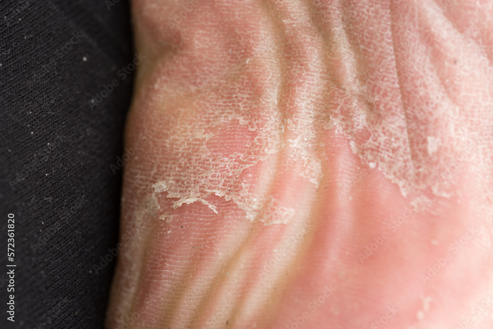 Fototapeta premium Foot skin Cracked up dead skin peel desquamation medical condition flaking