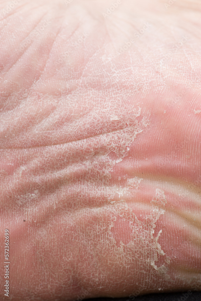 Foot skin Cracked up dead skin peel desquamation medical condition flaking Foot skin Cracked up dead skin peel desquamation medical condition flaking