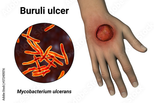 Buruli ulcer on an arm, 3D illustration. The disease caused by Mycobacterium ulcerans bacteria photo