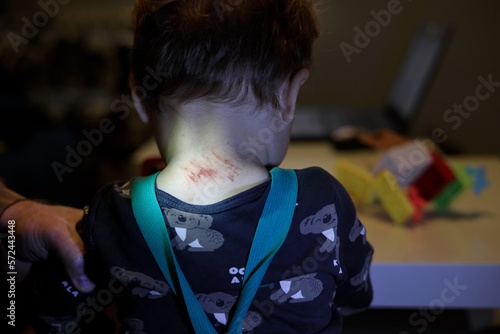 The picture showing the scratched neck of a child after an allergy can also be used as an illustrative cartoon about abused children