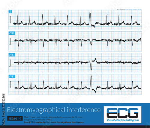 When the baseline of ECG is interfered by its own or external electrical signal, it will affect the shape and measured value of ECG wave, especially ST segment offset amplitude.