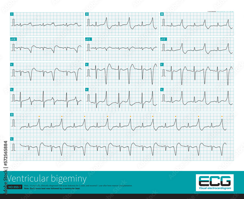 Some ventricular bigeminy are precursors of ventricular tachycardia, a