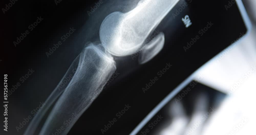 X-ray image of human knee. Problems with bone or joint. X-ray image of human knee. Problems with bone or joint.