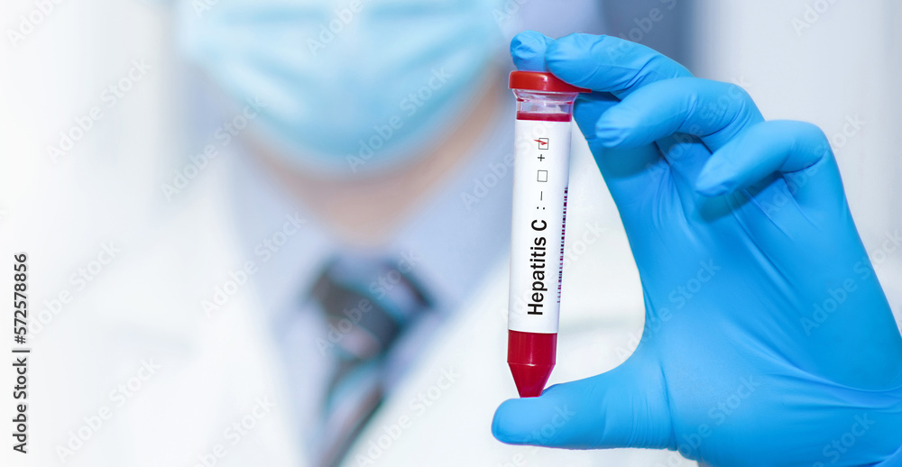 Doctor holding a test blood sample tube positive with hepatitis C virus (HCV) test. Doctor holding a test blood sample tube positive with hepatitis C virus (HCV) test.
