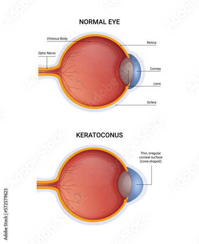 Keratoconus disease vector infographic, normal eye and keratoconus illustration design