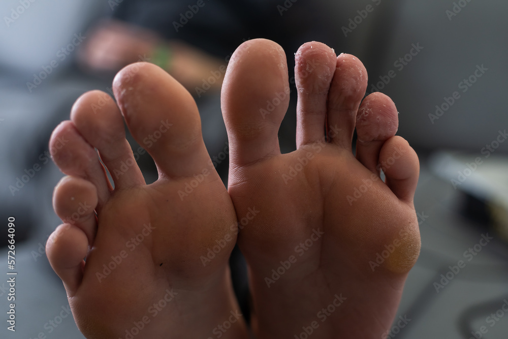 A man's toes showing what looks like a rash with red blotchy skin. A