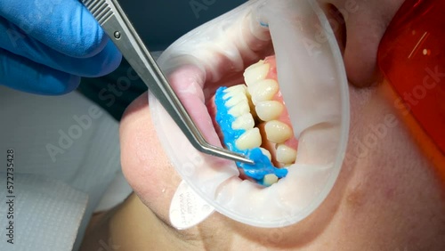 dentistry close-up doctor's hand removes hardened liquid rubber dam to isolate gums from active substance of teeth whitening glasses on woman protecting from photopolymer whitening lamp by American photo