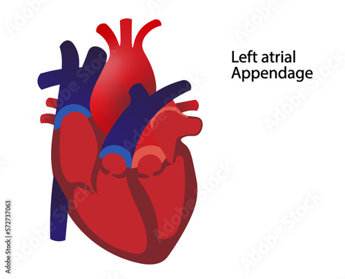 Left atrial appendage (LAA) illustration. Illustration of the LAA open