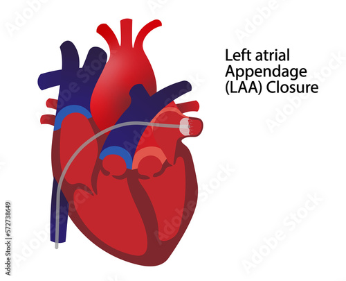 Left atrial appendage (LAA) illustration. Illustration of the LAA closure with a catheter photo