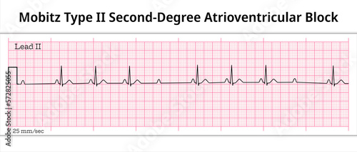 ECG Mobitz Type 2 Second Degree Atrioventricular Block - 2nd degree AV Block - 8 Second ECG Paper - Electrocardiography Vector Medical Illustration