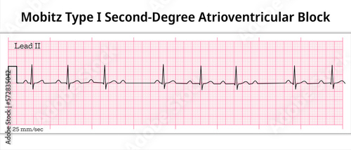 ECG Mobitz Type 1 Second Degree Atrioventricular Block - 2nd degree AV Block - 8 Second ECG Paper - Electrocardiography Vector Medical Illustration