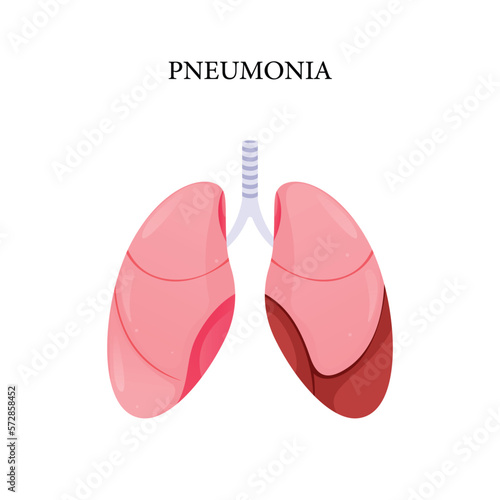 Vector pneumonia disease, illustration design for medical