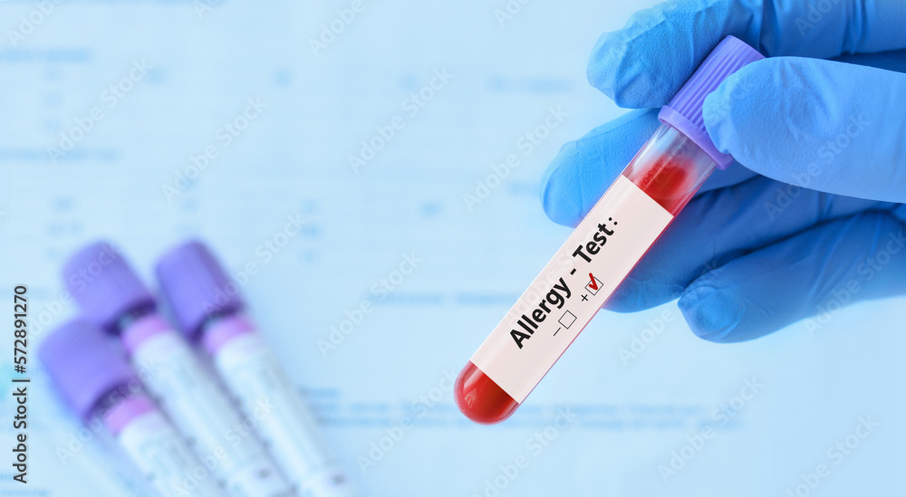 Doctor holding a test blood sample tube positive with allergy test on the background of medical test tubes with analyzes. Doctor holding a test blood sample tube positive with allergy test on the background of medical test tubes with analyzes.