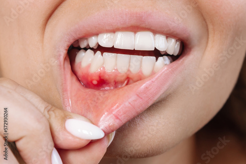 Close up of a ulcerative stomatitis on the gums. Gum inflammation. Cropped shot of a young woman showing red bleeding gingiva with an ulcer. Dentistry, dental care concept photo