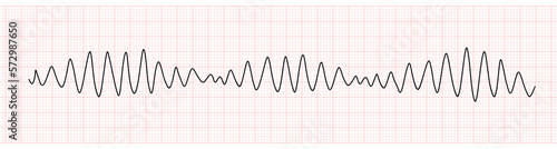 EKG Monitor Showing Polymorphic Ventricular tachycardia or VT: Torsades de pointes photo