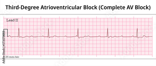 ECG Third Degree Atrioventricular Block - Complete AV Block - 8 Second ECG Paper - Electrocardiography Vector Medical Illustration