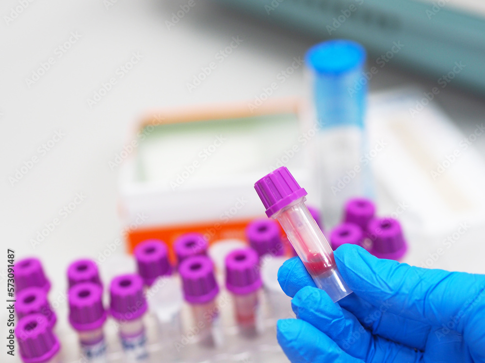 EDTA Blood sample for Complete blood cell count(CBC) testing. Hand in gloves holding blood test tube on lab room background.
EDTA Blood sample for Complete blood cell count(CBC) testing. Hand in gloves holding blood test tube on lab room background.