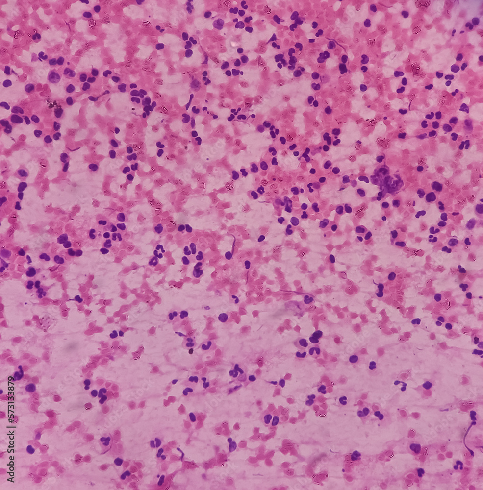 Gluteal region Tumor Cytology. Myeloid sarcoma. Chronic myeloid leukemia. Smear show cellular material composed of immature mononuclear cells admixed with polymorphs, lymphocytes and histiocytes.