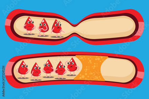 Blood drop character cartoon set collection, cute, happy , smiling, strong healthy and unhealthy atherosclerosis. blood cannot pass through vessels. vector modern trendy flat style cartoon.