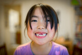 Young asian girl losing front two baby teeth