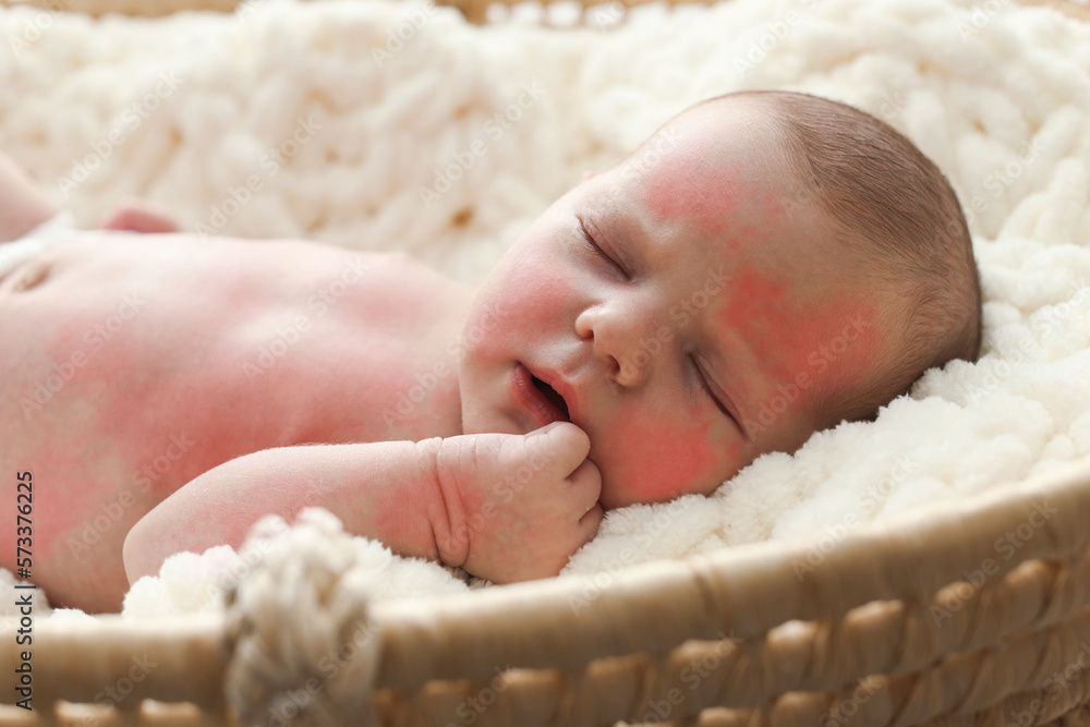 Cute little baby with allergic redness sleeping in soft cradle, closeup Cute little baby with allergic redness sleeping in soft cradle, closeup