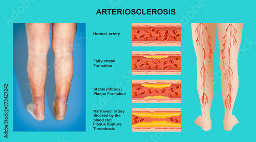 Obraz na płótnie Human legs. Artery with blood cells desease. Concept of dry skin, old senior people, varicose veins and DVT. w salonie