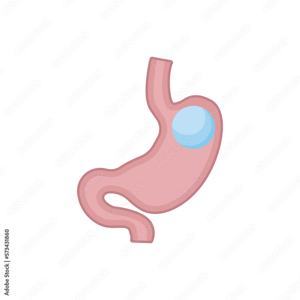 Gastric balloon. Vector illustration on white background