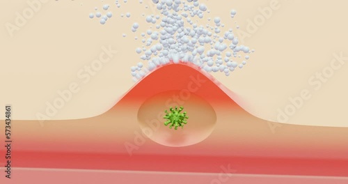 Viral subcutaneous inflammation, herpes - 3d animation showing symbolic dermatitis with a virus, and treatment with a cream. photo