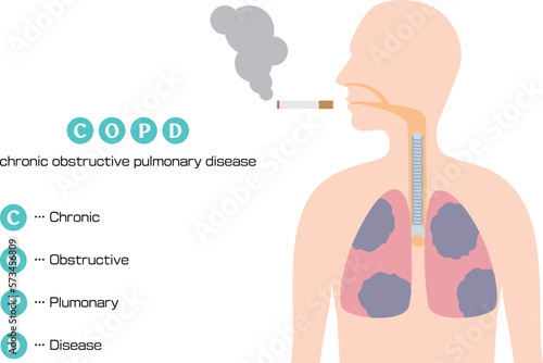 慢性閉塞性肺疾患「COPD」のイラスト／Illustration of chronic obstructive pulmonary disease "COPD"