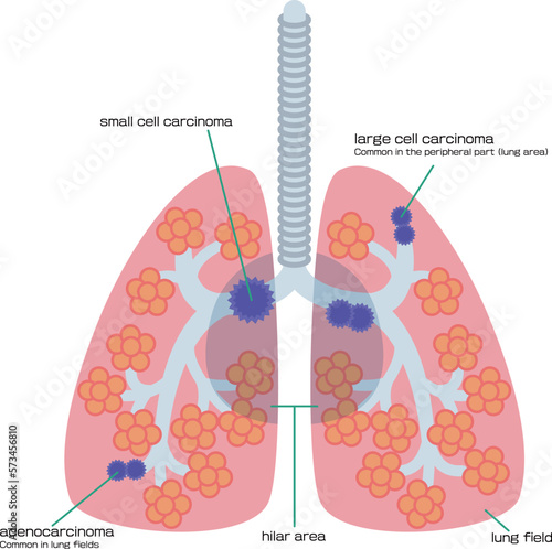 肺がんの腫瘍ができる場所を示したイラスト／Illustration showing where lung cancer tumors form