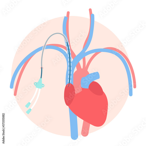Tunneled central venous catheter placed in the subclavian vein. Patient with CVC long term access device for chemotherapy infusions and blood sampling. Central line tube close up. Vector illustration.