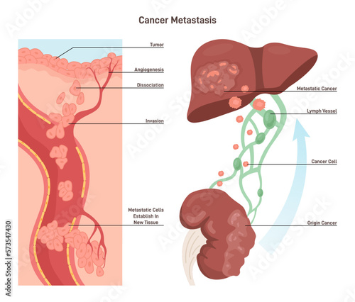 Process of metastasis. Formation of tumor in a tissue of secondary