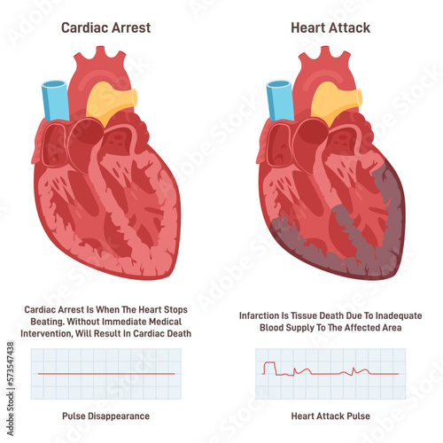 Cardiac arrest vs heart attack. Heart diseases comparison. Electrical signal