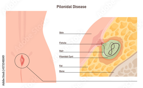 Pilonidal disease. Skin infection or cyst with ingrown hair between photo