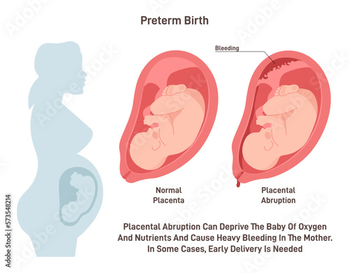 Preterm birth. Placental abrupted and early baby delivery. Pregnancy