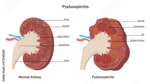 Pyelonephritis. Kidney infection disease, inflammation of organ tissue