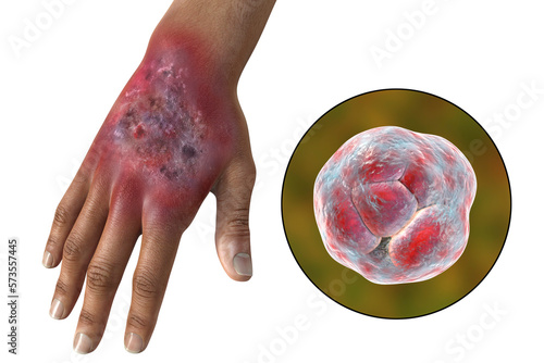 Protothecosis infection on human hand and close-up view of Prototheca wickerhamii green algae, 3D illustration photo