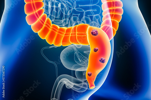 Rectum or colorectal cancer with organs and cancerous cells 3D rendering illustration with male body. Anatomy, oncology, bowels or intestinal disease, medical, biology, science, healthcare concepts. photo
