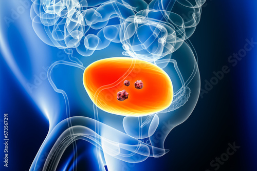 Photos Urinary bladder cancer with organs and tumors or cancerous cells 3D rendering illustration with male body